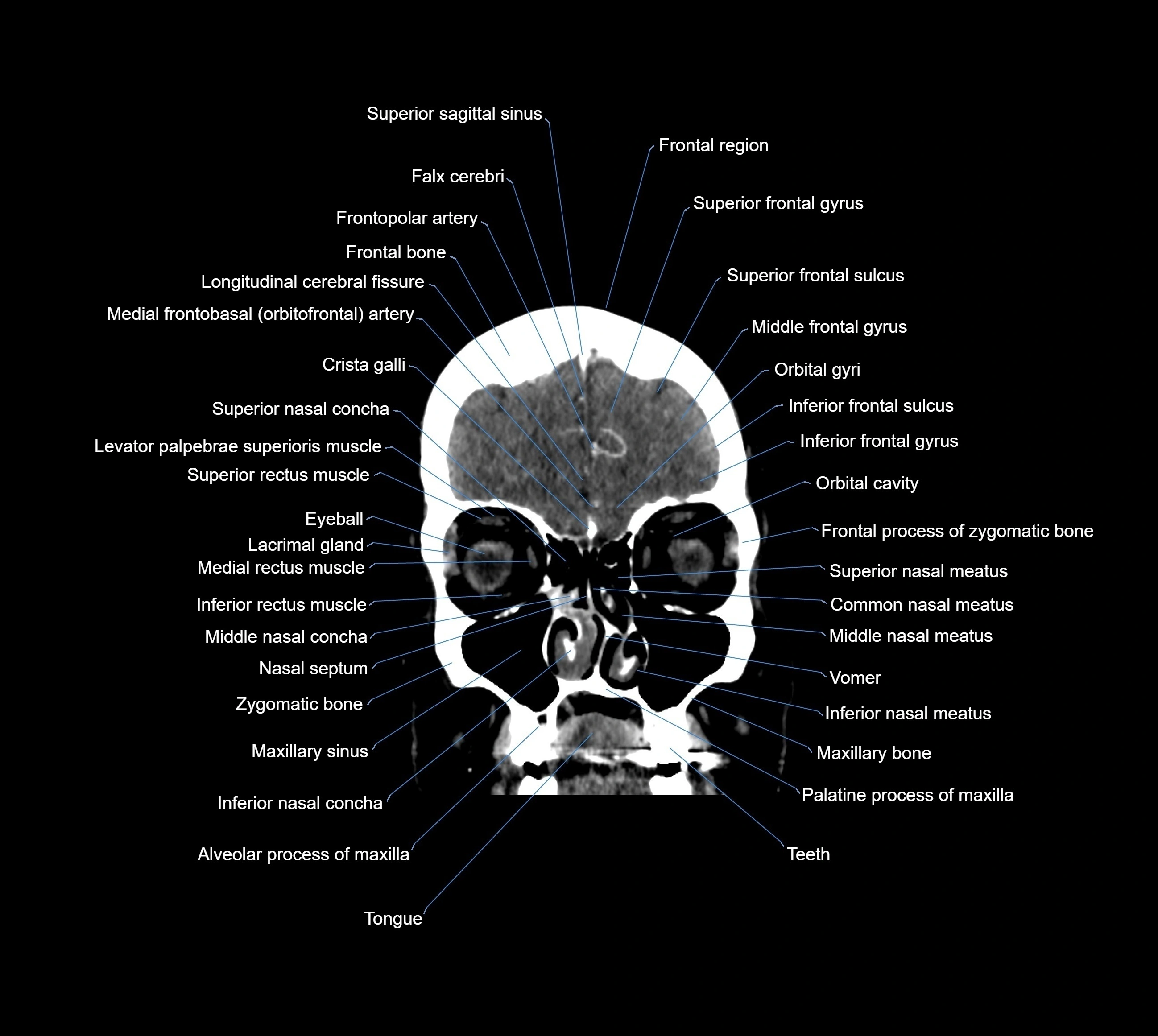 CT Brain coronal cross sectional radiology anatomy image  -img-00001-010.webp